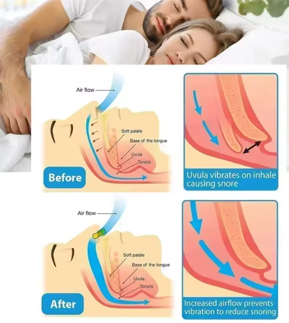 Reduce Snoring Naturally and Comfortably PACKAGE OF 4 CLIPS ΜΕΙΩΣΤΕ ΤΟ ΡΟΧΑΛΗΤΟ ΜΕ ΦΥΣΙΚΟ ΚΑΙ ΒΟΛΙΚΟ ΤΡΟΠΟ